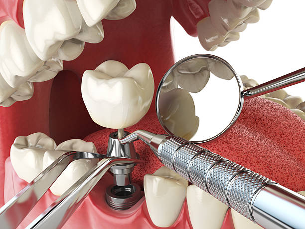 Best Emergency Treatment for Dental Infections or Abscesses in North Edwards, CA